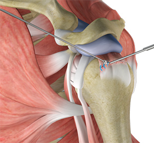 Arthroscopic Rotator Cuff Repair