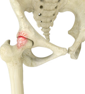 Femoroacetabular Impingement