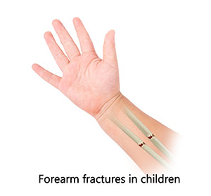 Forearms Fracture in Children