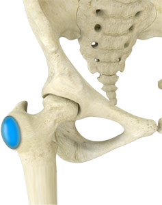 Hip Bursitis