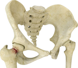 Hip Dislocation