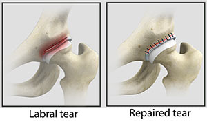 Hip Labral Tear