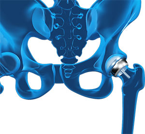 Hip Resurfacing 