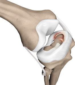 Meniscal Tears