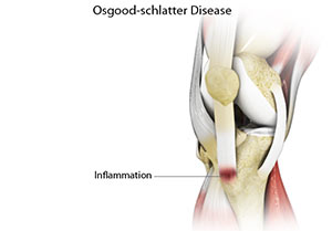 Osgood Schlatter Disease