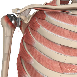 Revision Shoulder Replacement