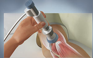 Shock-wave Therapy