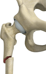 Subtrochanteric Hip Fracture