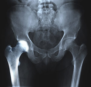 Transient Osteoporosis of the Hip  